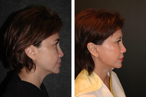 asian-facelift-before-after-patient-06b-7912466